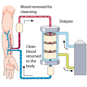 Kidney Diseases, Dialysis and Transplant Questions - Questions by Topic — Online A level Biology Tutor Kidney Diseases, Dialysis and Transplant Questions - Questions by Topic — Online A level Biology Tutor