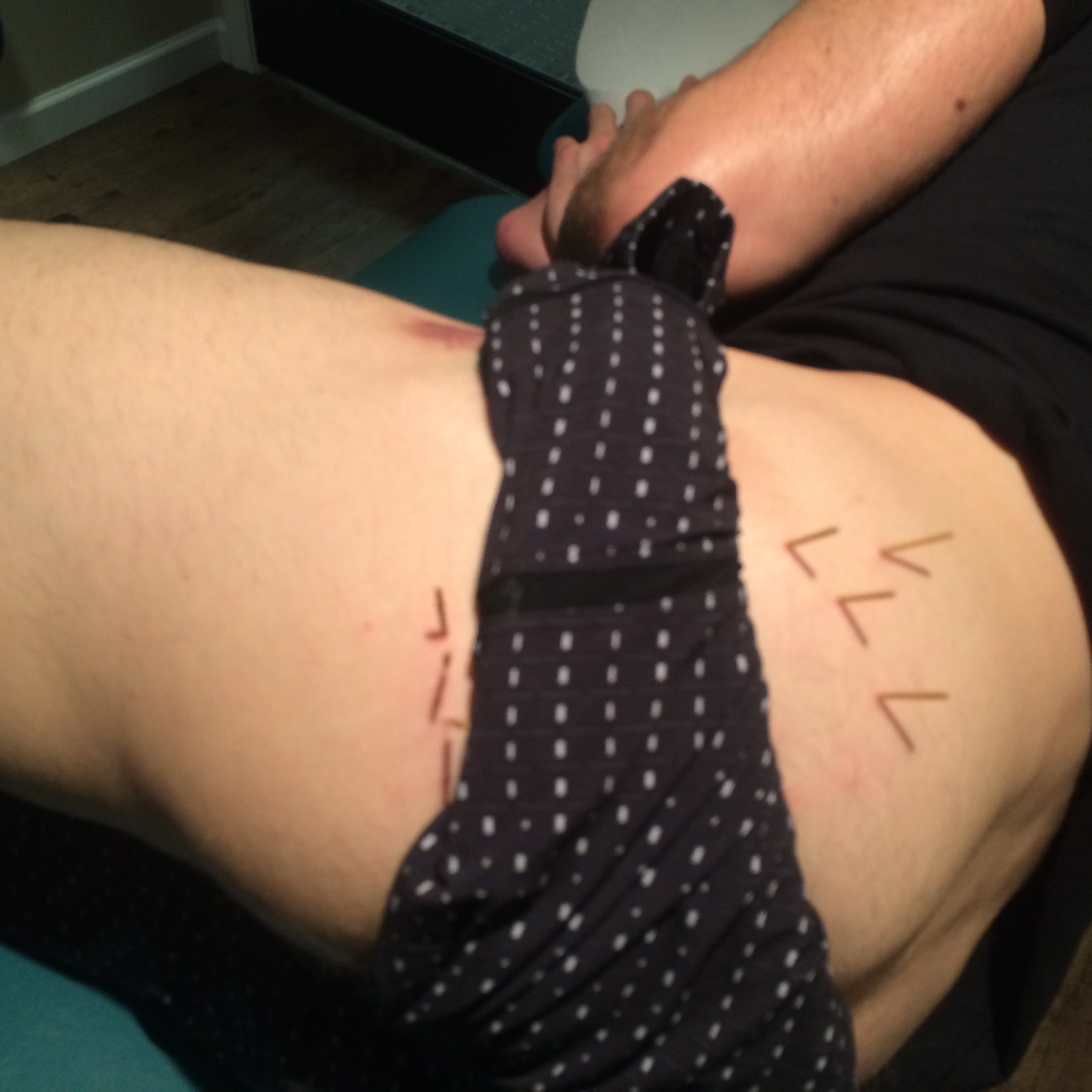 At the physio getting IMS: those needles are about 60mm in, but it looks worse than it is. Feels great after!