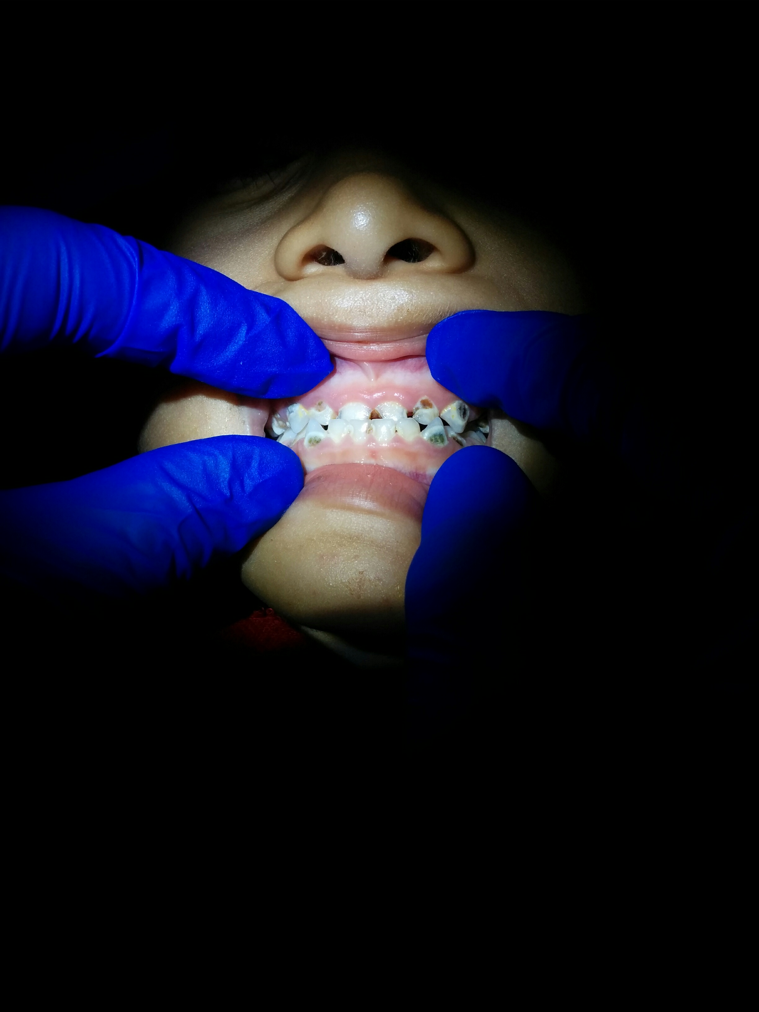 Multiple areas of tooth decay can be seen in the form of areas of brown discolouration in this young patient's mouth. 