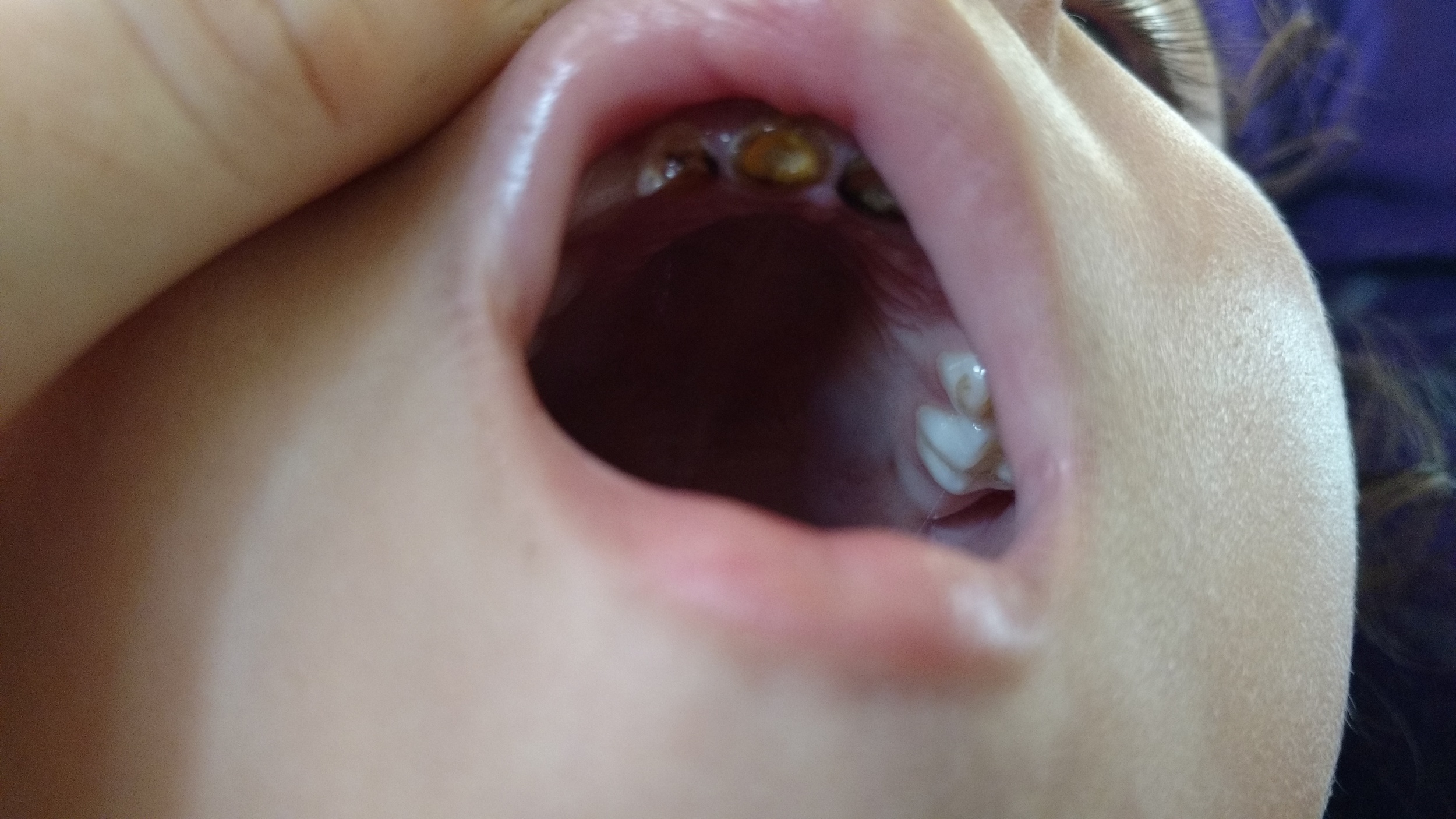 Severe dental decay in a 5 year old girl. 