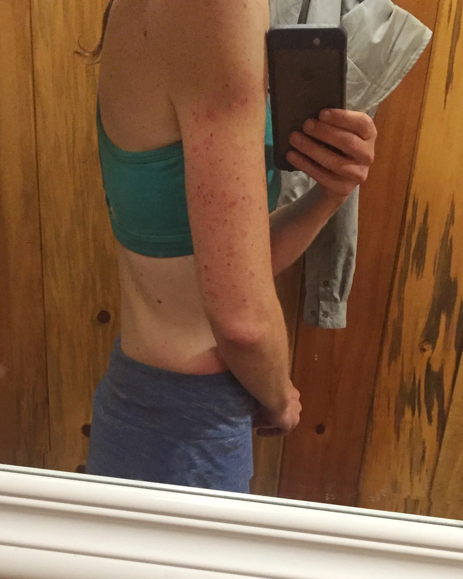 Measles? Or just a hundred mosquito bites. This is why thru-hikers should never look in the mirror!