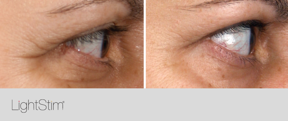 red light therapy for under eye circles