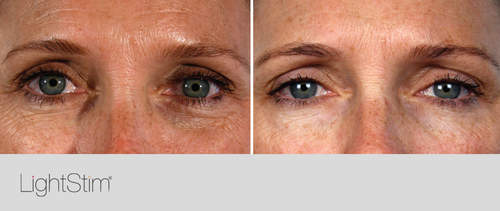 Tick fisk Saks Before & After / LED Red Light Therapy — Glazer Facial Plastic & Cosmetic  Surgery
