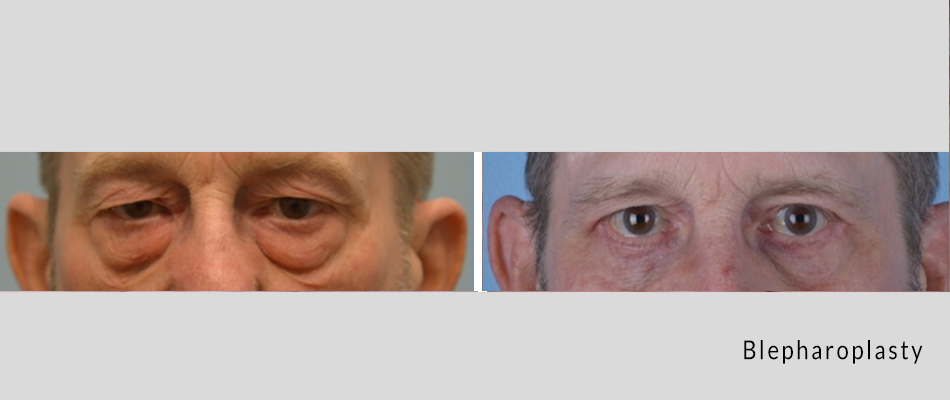 blepharoplasty01.png