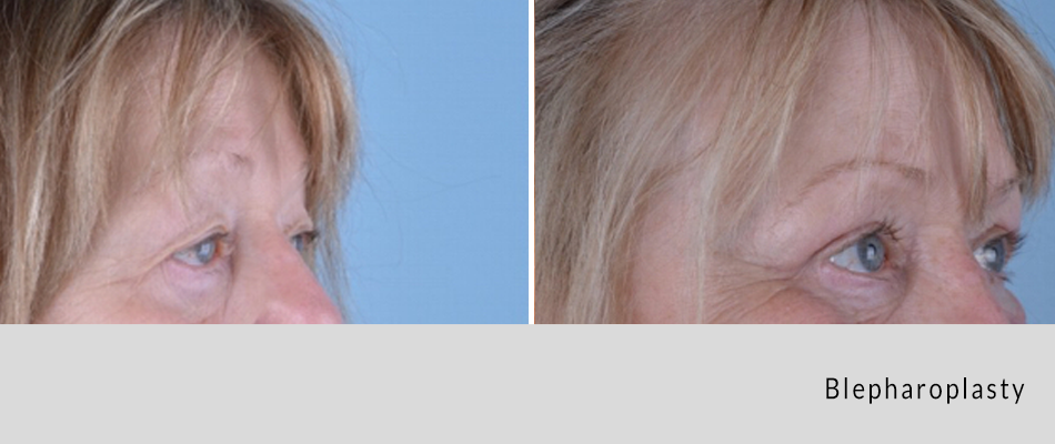 blepharoplasty04.png