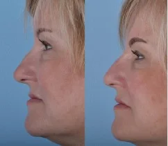 Non-Surgical Rhinoplasty