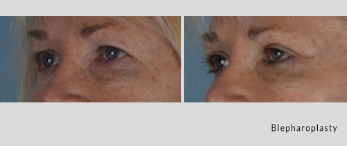 blepharoplasty 4-19-1.jpg