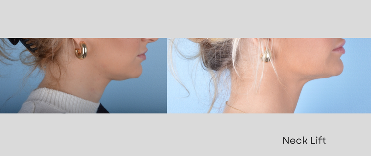 Copy of Copy of Glazer  Before and After Website (9).png