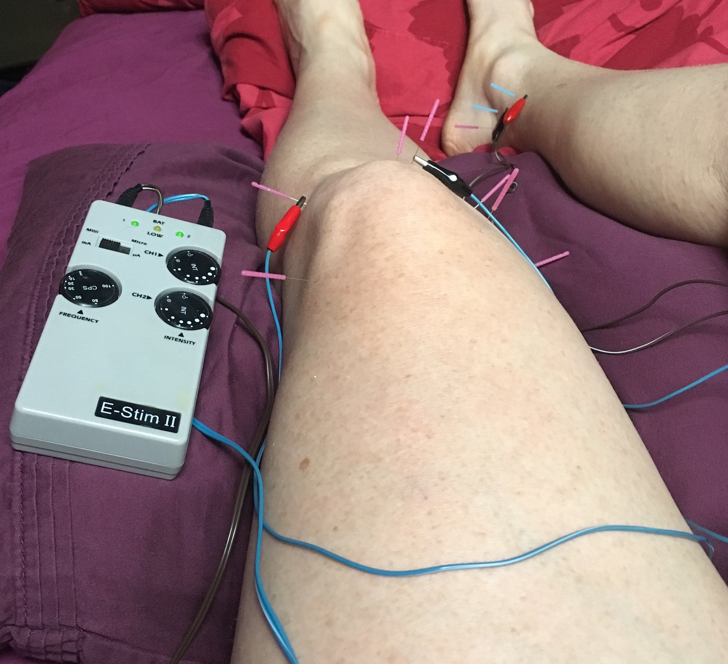 Acupuncture with E-stim.