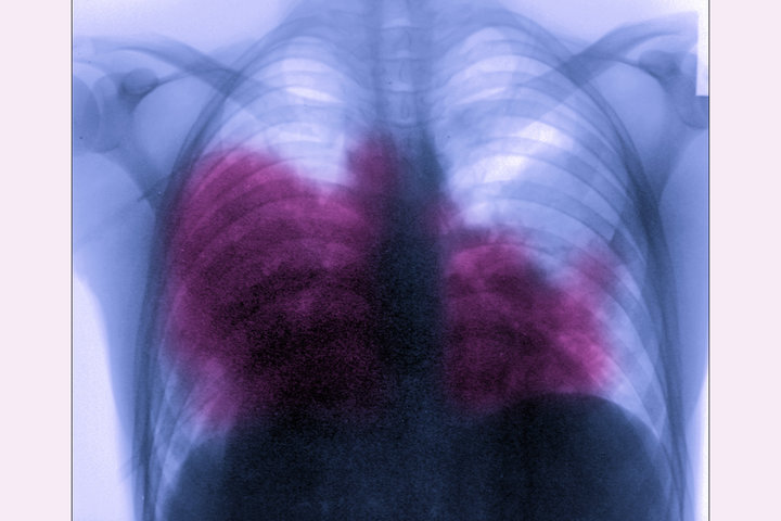 BSIP/UIG VIA GETTY IMAGES Acute bilateral pneumonia, aka Legionnaires’ disease, is seen on a chest X-ray.