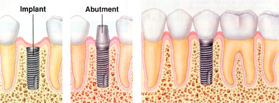 dental implant 2.jpg