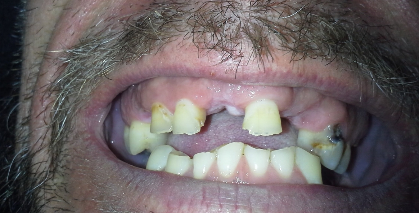 Tim before the procedure.