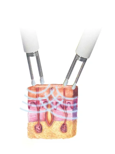 Microcurrent in action
