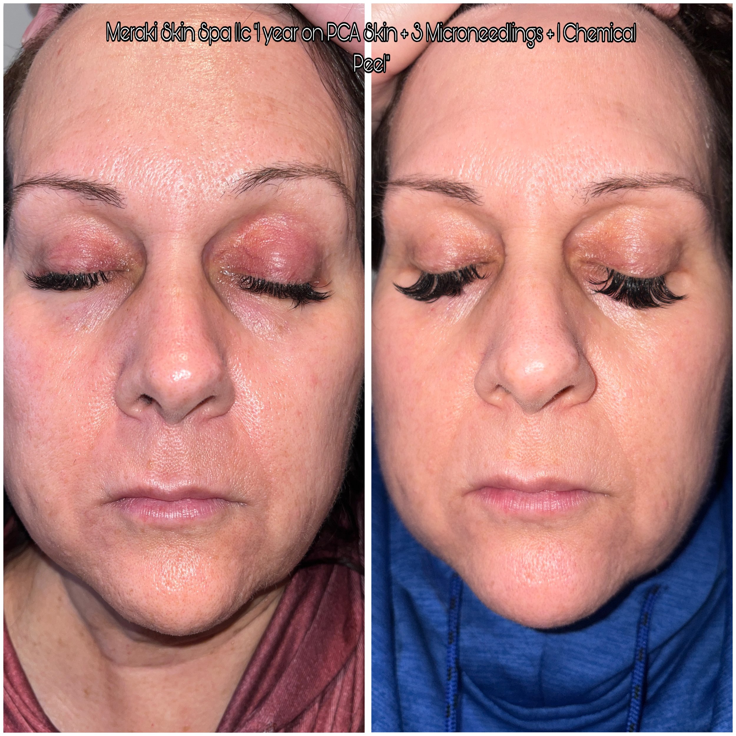 lash lift wrinkle treatment microneedling and chemical peel pca skin care facial and lash lift meridian idaho day, spa, best facial near me, anti aging facial, treatment for wrinkle
