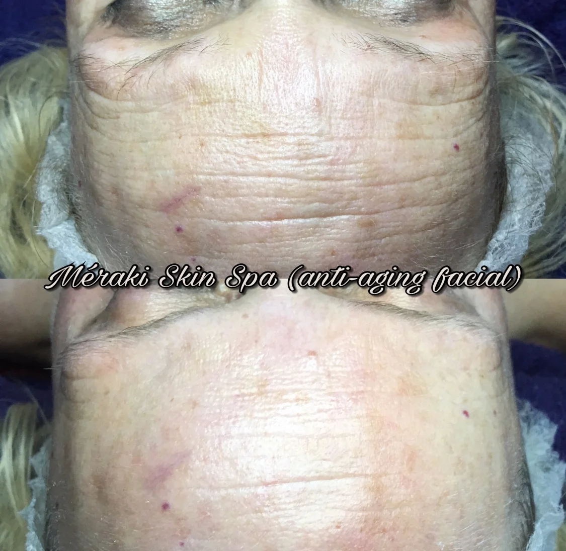 Best anti aging facial near me meridian idaho, med spa day spa, hydrating facial, facial for older women, pca skin care, facial for men, wrinkle reduction