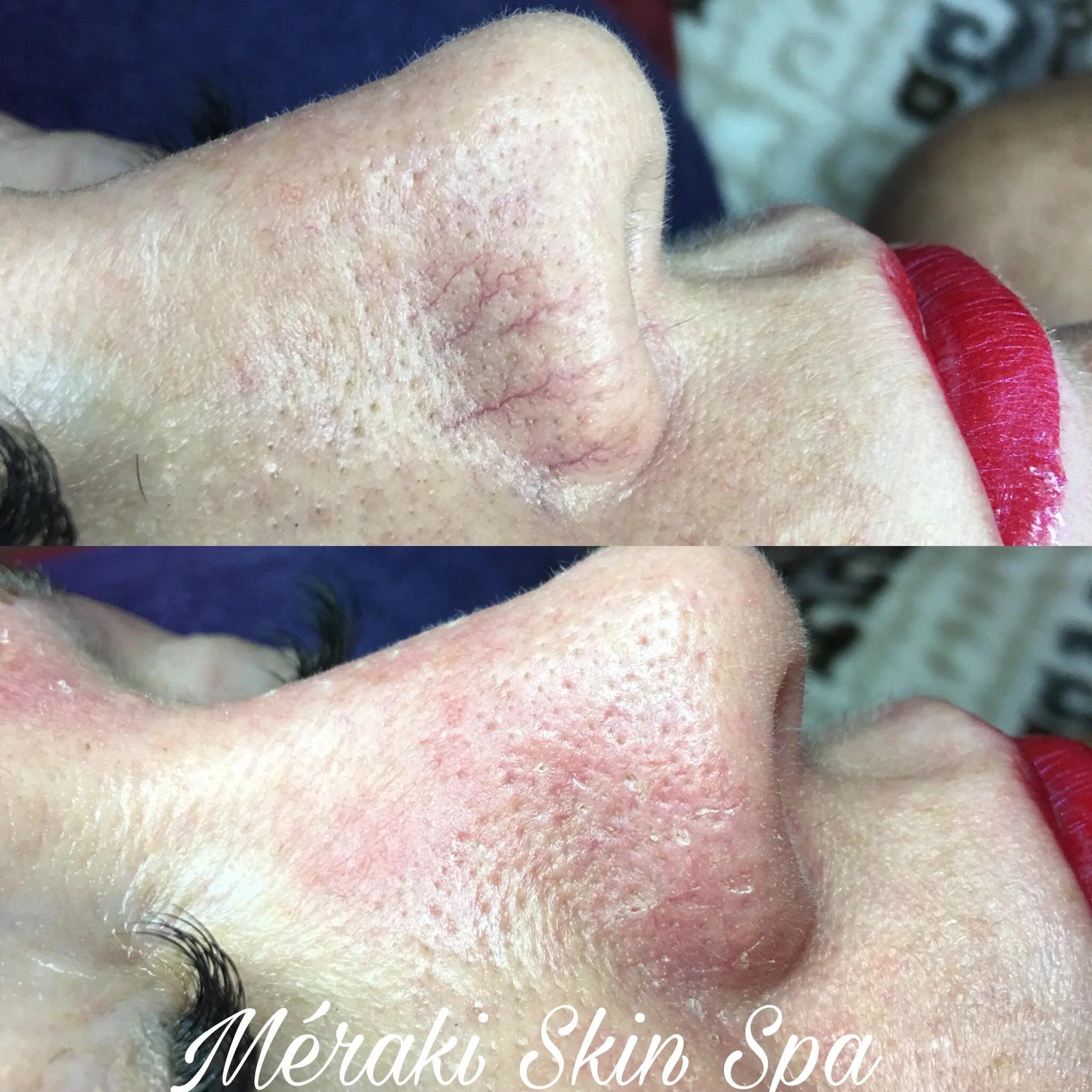 deep microneedling, acne mark treatmentsun spot removal-hyperpigmenation removal, skin tag removal, red face vein treatment, meridian idaho, best day spa, med spa