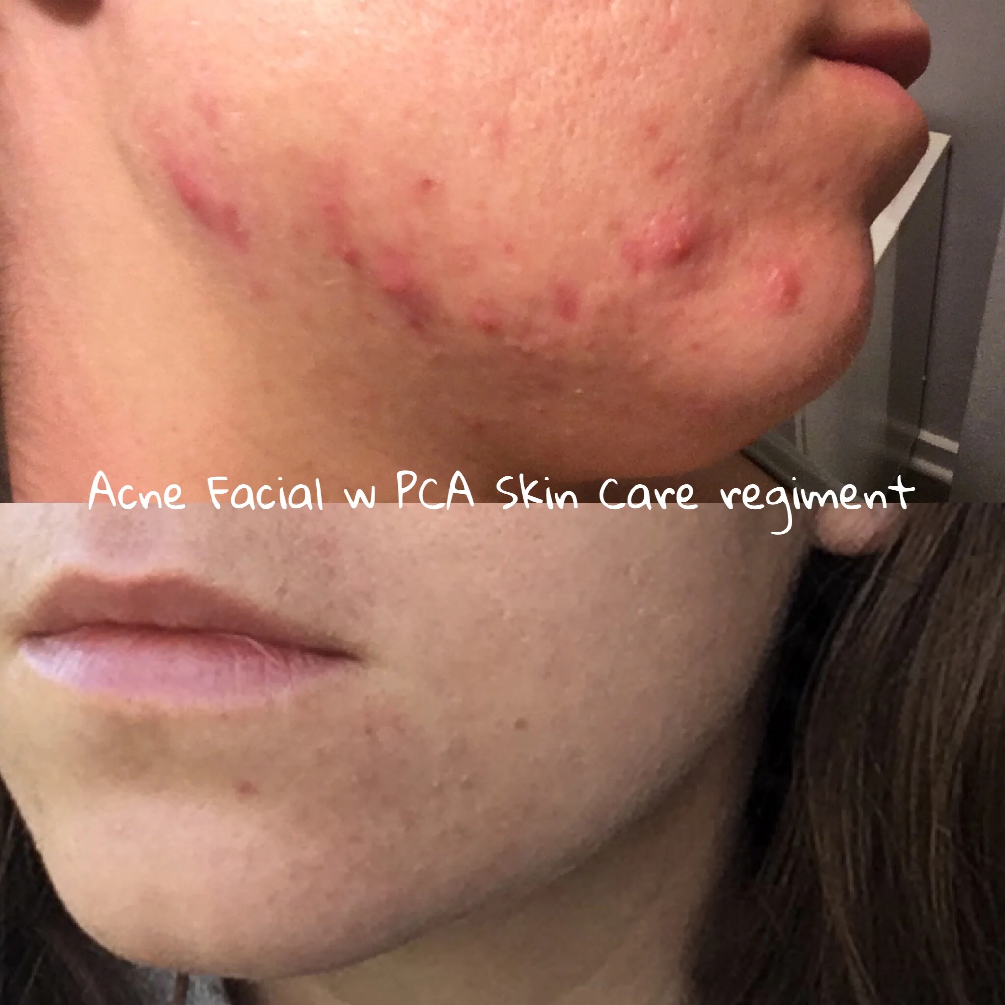 miconeedling near me, Best anti aging facial near me meridian idaho, med spa day spa, hydrating facial, facial for older women, pca skin care, facial for men, acne treatment, teen acne treatment, wrinkle reduction