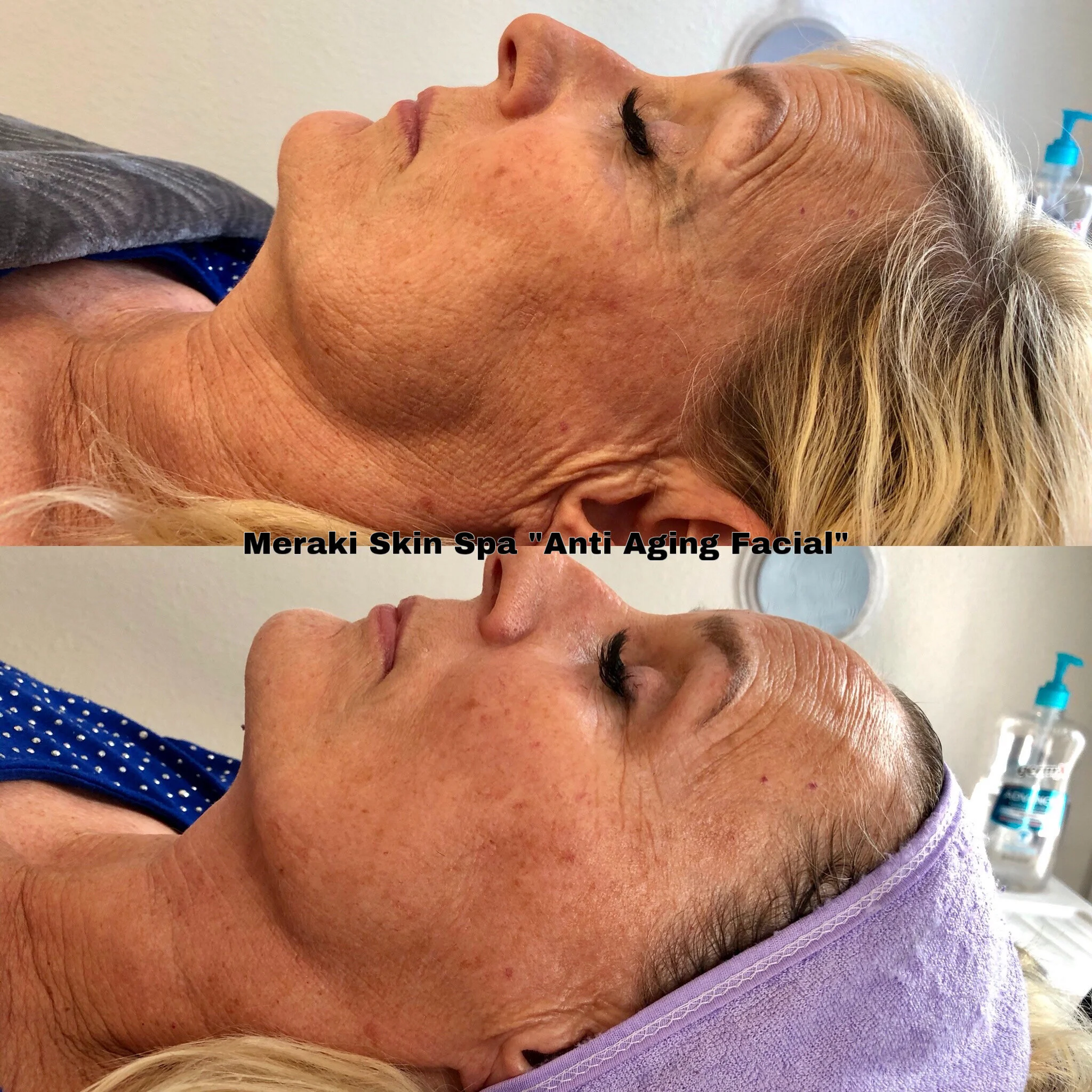 Best anti aging facial near me meridian idaho, med spa day spa, hydrating facial, facial for older women, pca skin care, facial for men, wrinkle reduction