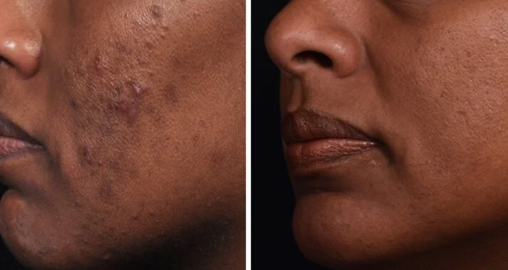 best facial near me, pca skin care, back acne, acne scarring treatment, pigmentation treatment, anti aging facial, med spa, day spa, facial, chemical peel, microneedling, acne treatment, teen acne treatment, chemical peel near me