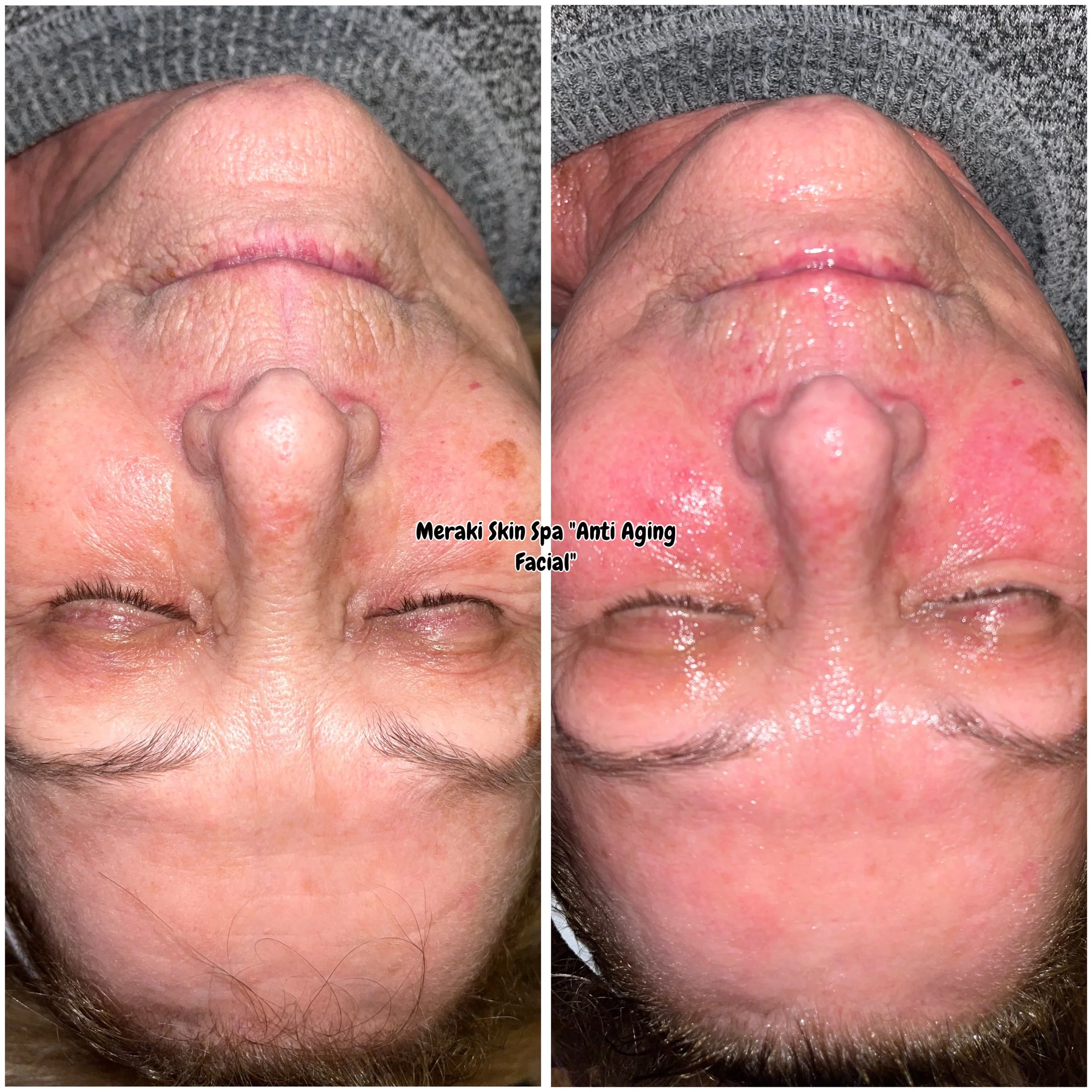 Best anti aging facial near me meridian idaho, med spa day spa, hydrating facial, facial for older women, pca skin care, wrinkle reduction