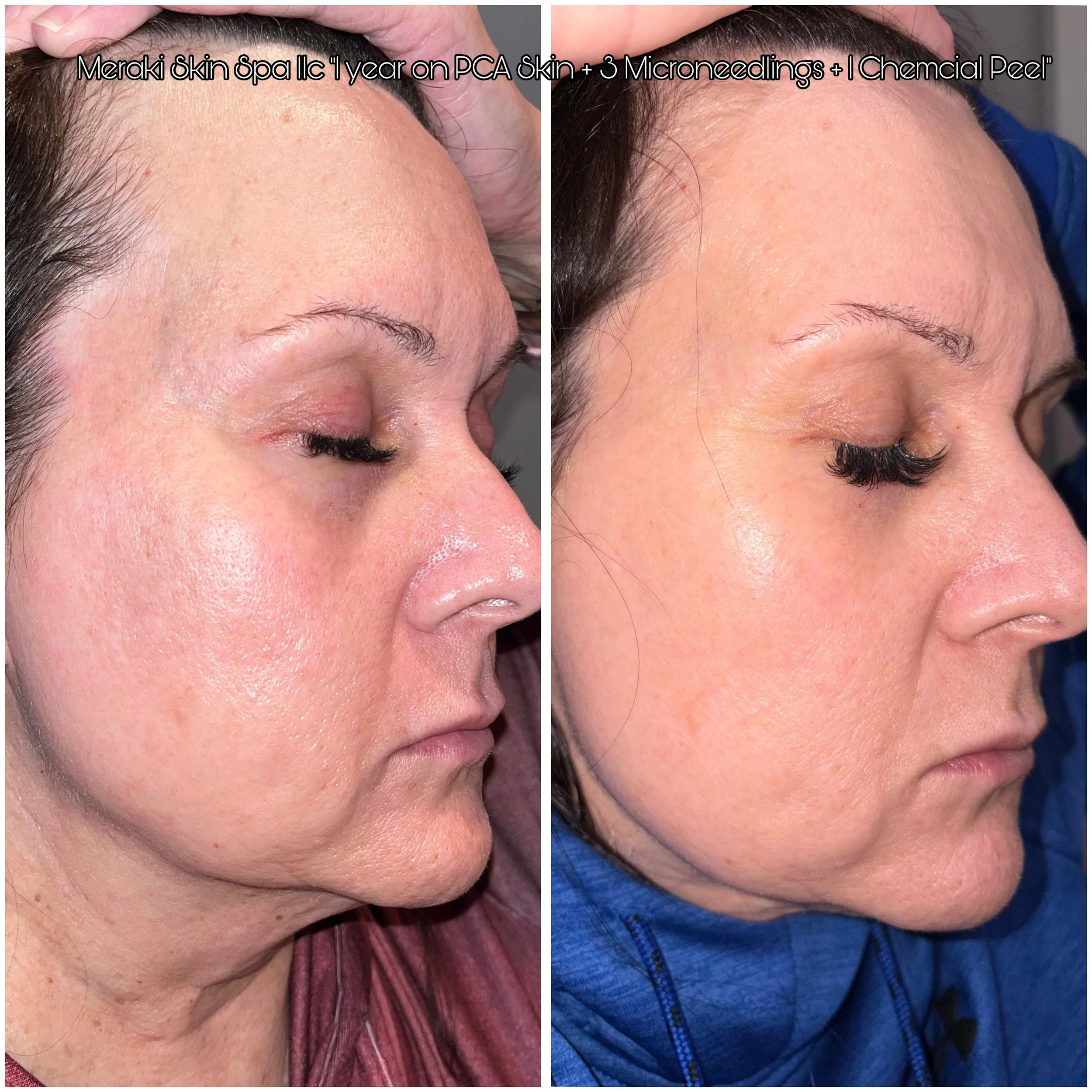 lash lift wrinkle treatment microneedling and chemical peel pca skin care facial and lash lift meridian idaho day, spa, best facial near me, anti aging facial, treatment for wrinkles