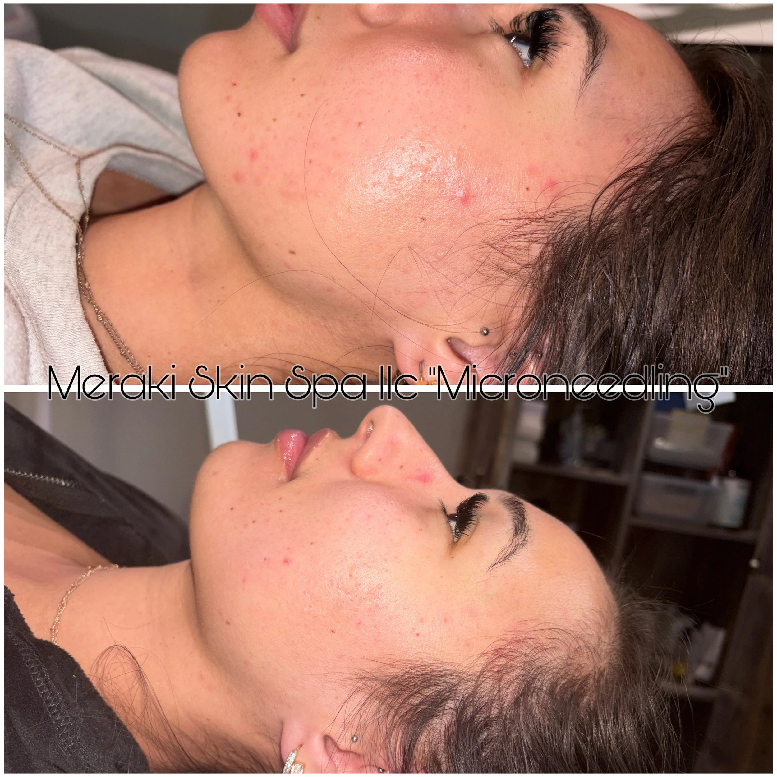 wrinkle treatment microneedling and chemical peel pca skin carefacial and lash lift meridian idaho day, spa, best facial near me, anti aging facial, treatment for wrinkles