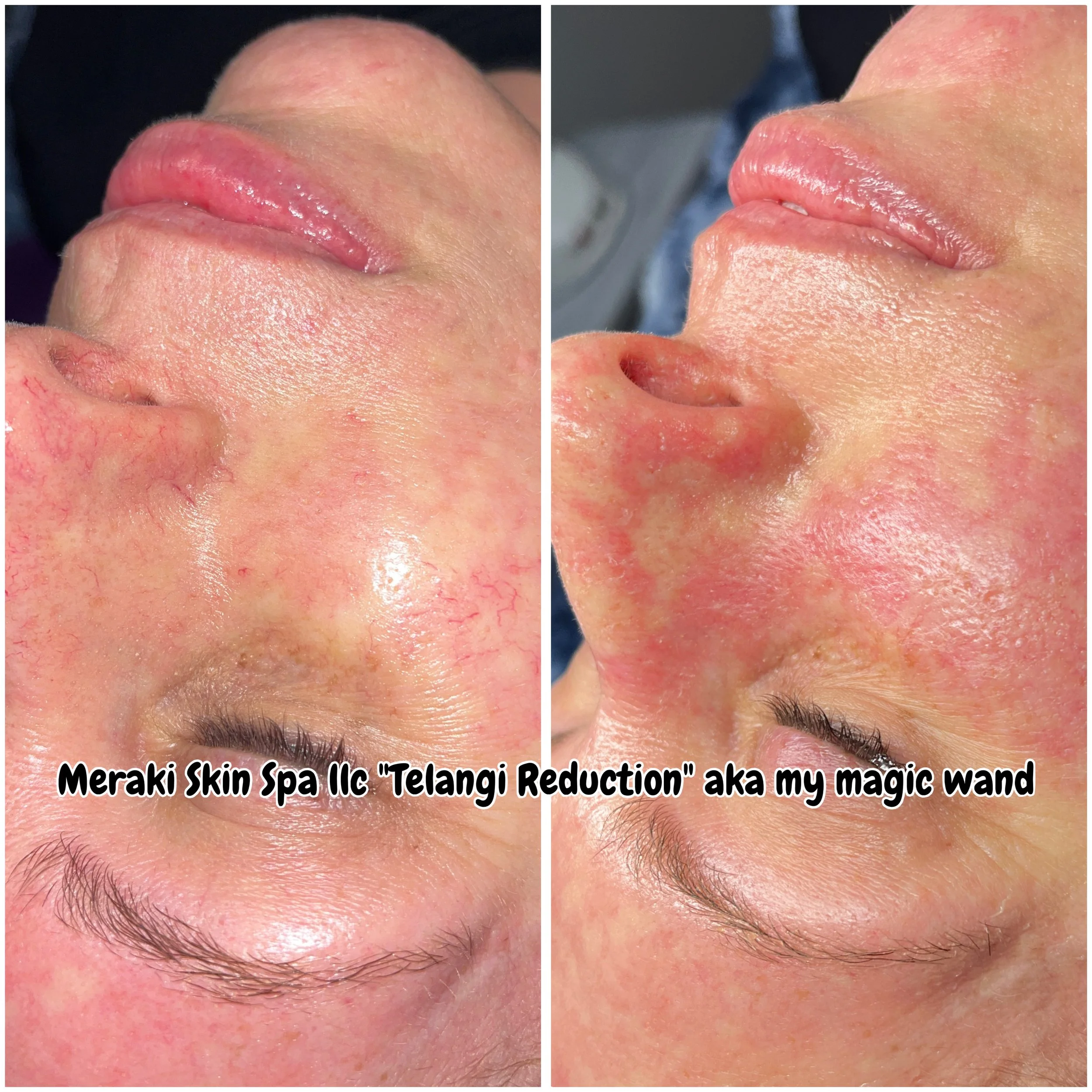 Meridian Idaho-day spa-med spa-skin care treatment-corrective facials-permanent makeup- tattooed eyeliner-micro blading-eyelash extensions-micro needling-chemical peels-lash lift-brow lamination-Eagle Idaho-Boise Idaho-PCA Skin-face vein removal