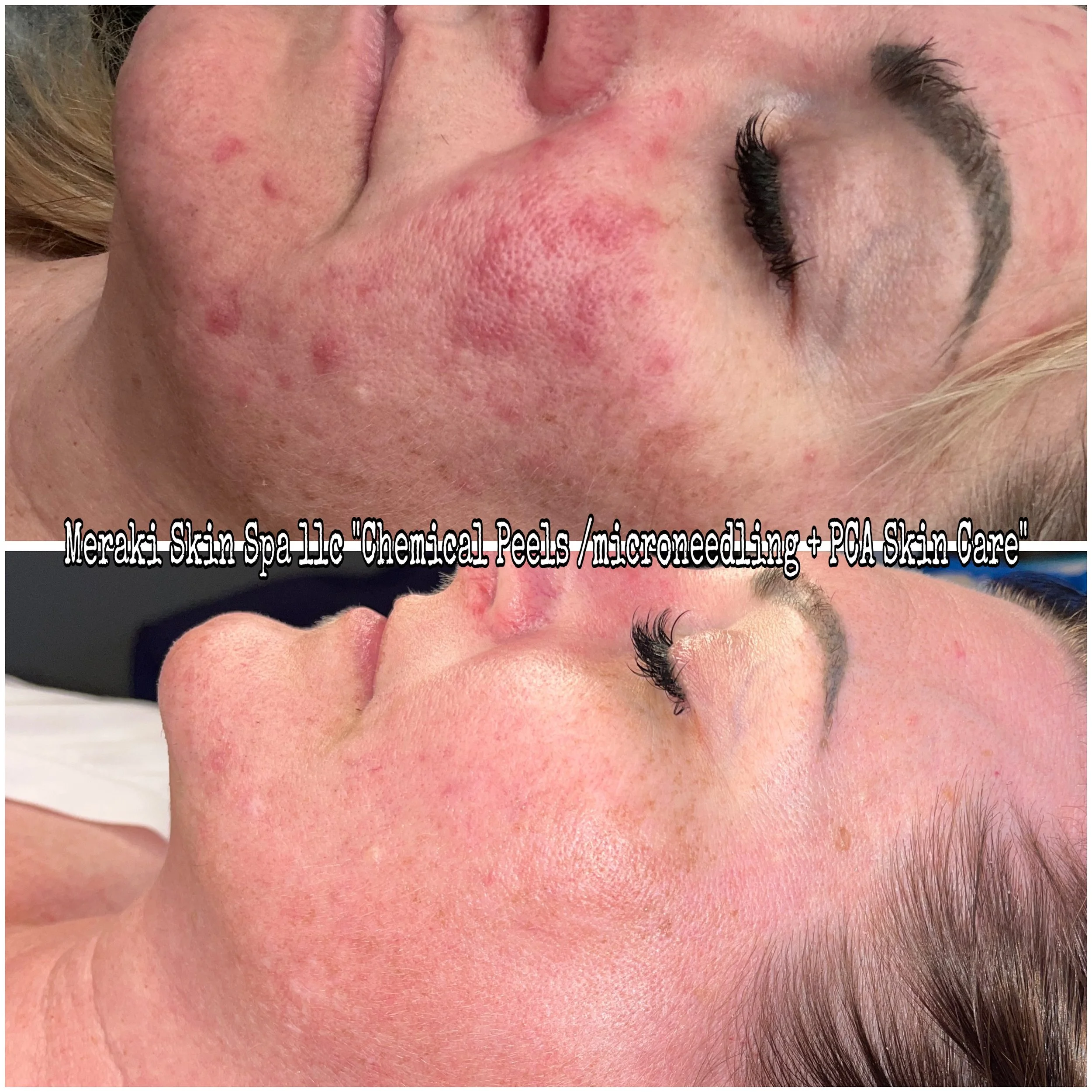 Meridian Idaho-day spa-med spa-skin care treatment-corrective facials-permanent makeup- tattooed eyeliner-micro blading-eyelash extensions-micro needling-chemical peels-lash lift-brow lamination-Eagle Idaho-Boise Idaho-PCA Skin-Esthetician near me