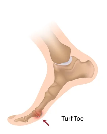 16911809_S_Turf Toe_Feet Bones.jpg
