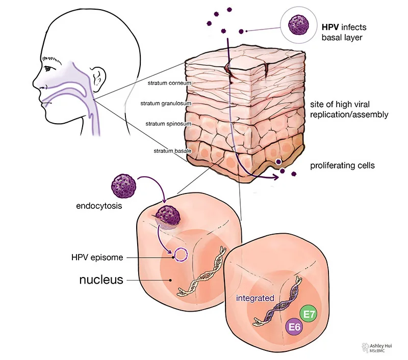 Figure caption: "Site of oropharyngeal cancer and HPV infection of the mucosal membrane: When there is a microabrasion or tear in the outer membrane, HPV virion can enter the mucosa and infect the proliferating cells in the basal layer. The virus enters the cell by endocytosis, and the genome can remain as an episome in the cytoplasm or enter the nucleus and integrate with the cellular DNA. When integrated, the oncoproteins, E6 and E7, can be expressed at stratum spinosum or stratum granulosum, where high viral replication occurs."
