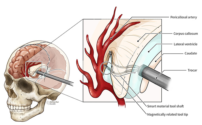 Figure caption: The smart material tool shaft features a two-pronged system that both grasps and cuts. The corpus callosum is then gently separated with the pericallosal artery marking the superior anatomical landmark.