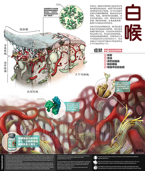Figure caption: Diphtheria is caused by the Gram-positive bacillus Cornebacterium diphtheriae , which releases a toxin that causes severe necrosis of the respiratory mucosa. Primarily affecting the nasopharynx, aggressive necrosis of the ciliated pseudostratified columnar epithelium ulcerates and a dense pseudomembrane forms. Complications arise three-fold: first, C. diphtheriae multiplies on the surface of this membrane – diphtheria is highly contagious via exposure from inhalation or physical contract with the infected – coughing is often a symptom, which release airborn secretions of diphtheria. Secondly, as the nasopharynx is highly vascularized, it provides a pathway for the diphtheria toxin to cause further systemic complications such as loss of motor function and heart failure. Lastly, the psudomembrane posesa physical threat, as it can potentially dislodge and cause asphyxiation. Diphtheria should be treated with antitoxin to counter the exotoxin released by C. diphtheriae , as well as erythromycin to eliminate the bacteria itself. Preventative measures (immunization) have proven extremely effective.
