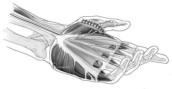 Figure caption: Surgical overview of the left hand and initial trauma to the thenar group from a table saw injury.