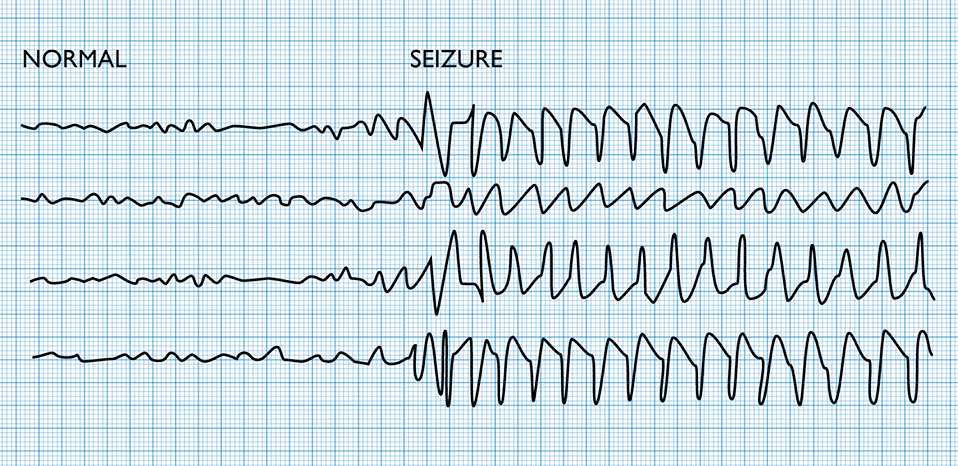 Brain waves as depicted on an EEG recording.