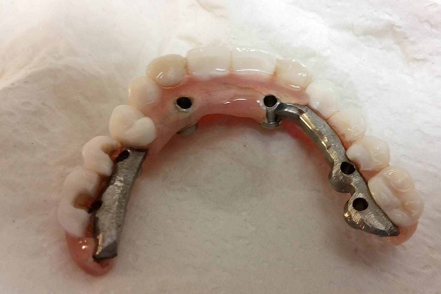  Here is an example of a hybrid that did not have the appropriate occlusal clearance. 