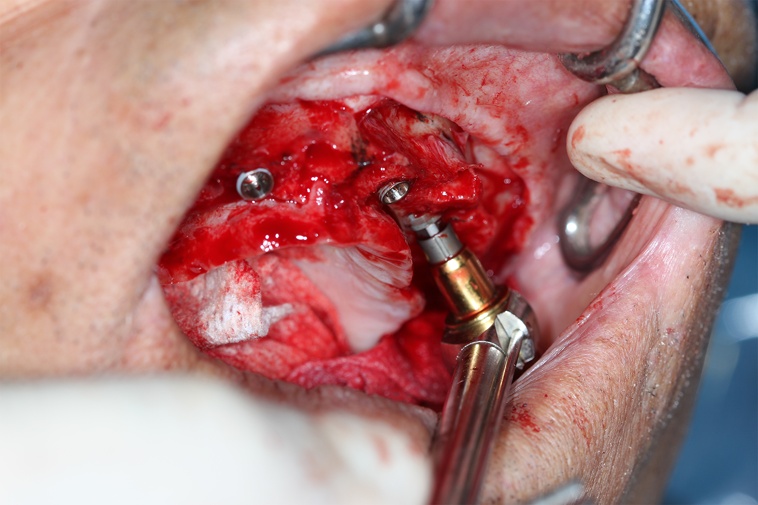  Torque the implant and scoop out a small area distal of the implant to allow for a 30 °&nbsp; multi-unit abutment. 