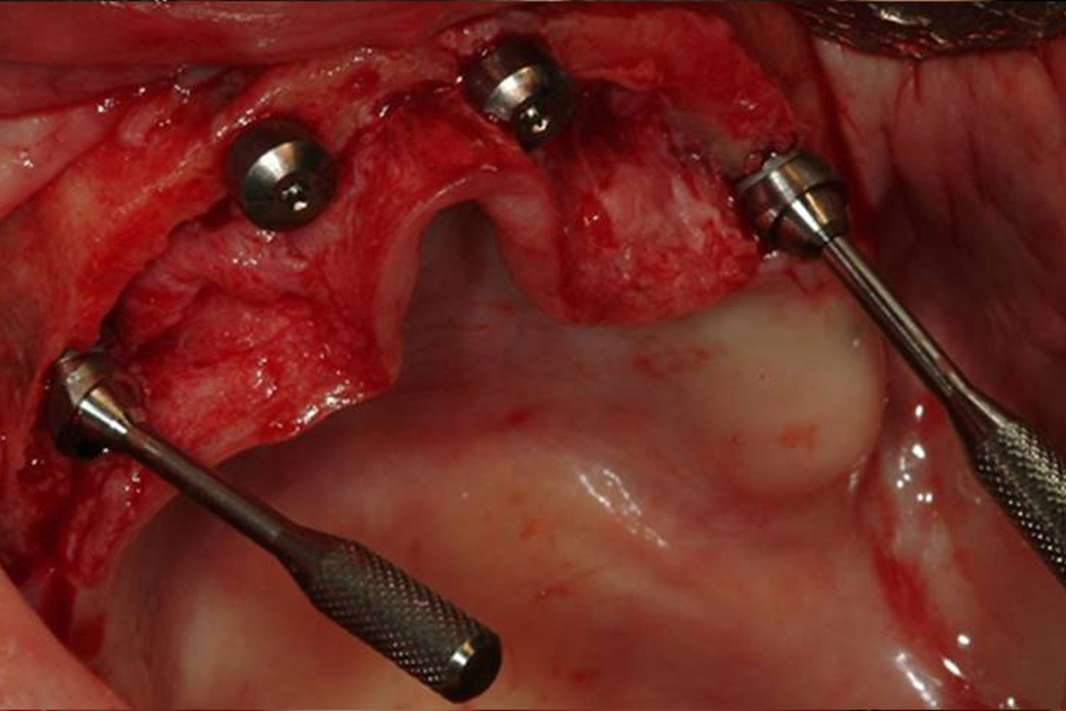  Once the posterior abutments are placed, verify they are parallel. 