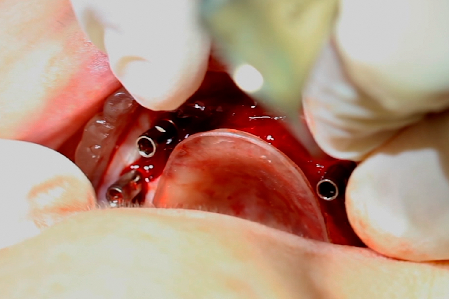  Utilize your bone/surgical guide for the accurate placement of the multi-unit abutments. 