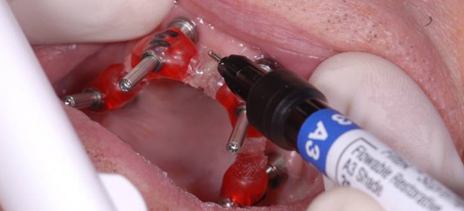 Lutte the jig together in the patient's mouth. 