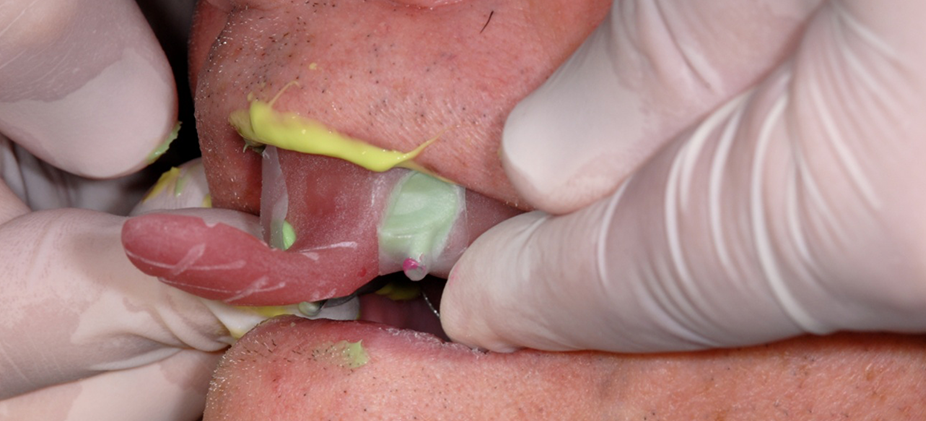  Take to patient's mouth following the same path of insertion previously practiced. 