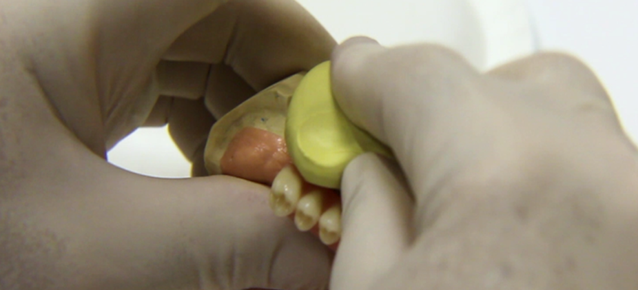  Apply material to model, acrylic on the buccal/facial side, the facial aspect of the teeth, and the occlusion. 