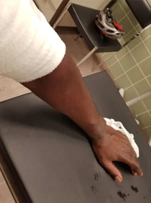 "Just when it couldn't get worse..... 5 stitches and big wound on the bicep. I'm good to go again."