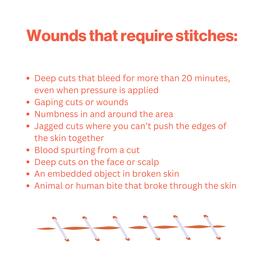 stitches
