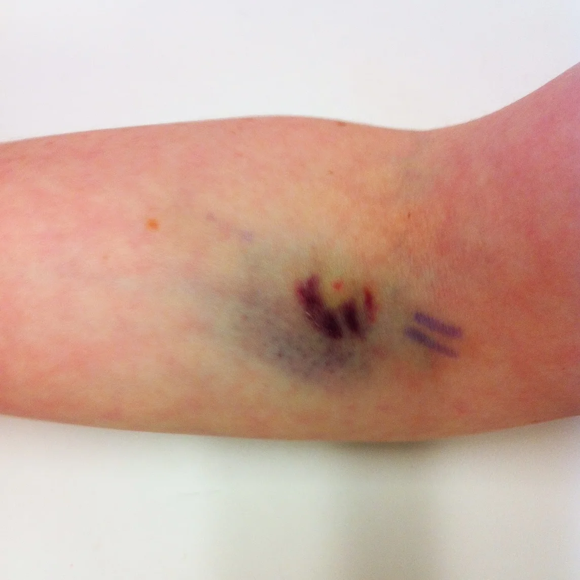 Update to #11 Donating Blood