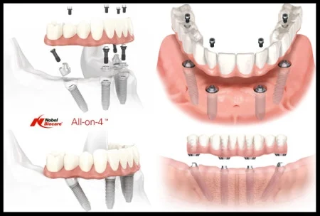 All on 4 Aparna Subramanian DDS 1.jpg