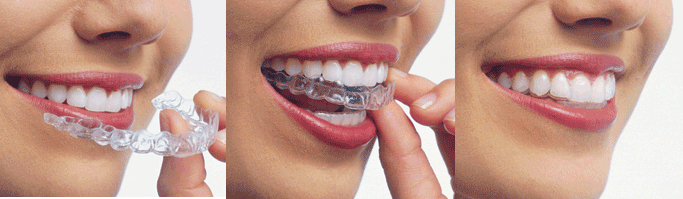 Invisalign-smile.gif