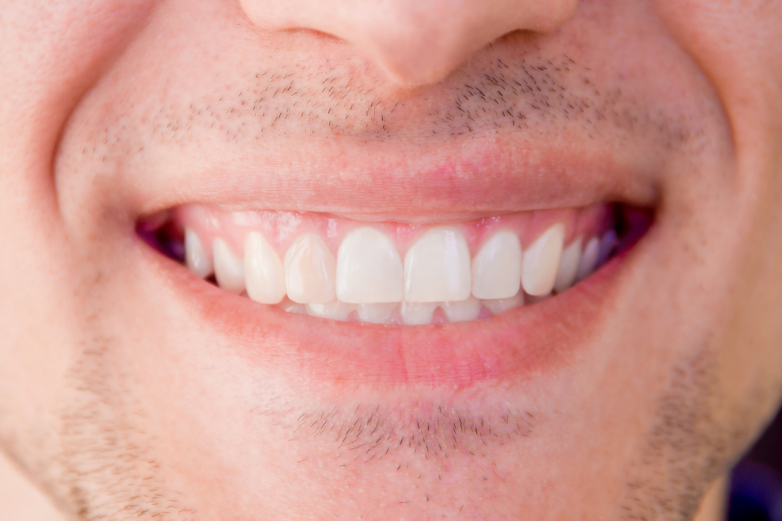 Improve the appearance of chipped or broken teeth