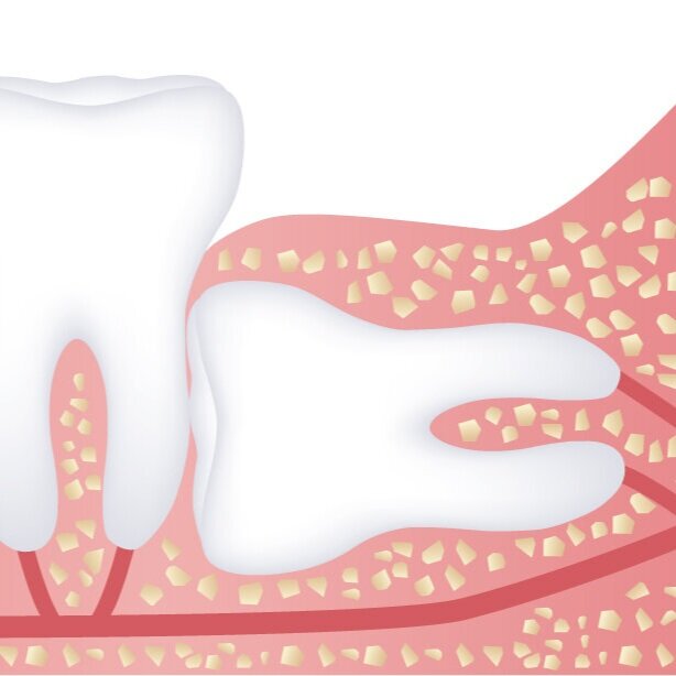 molar-complete.jpg