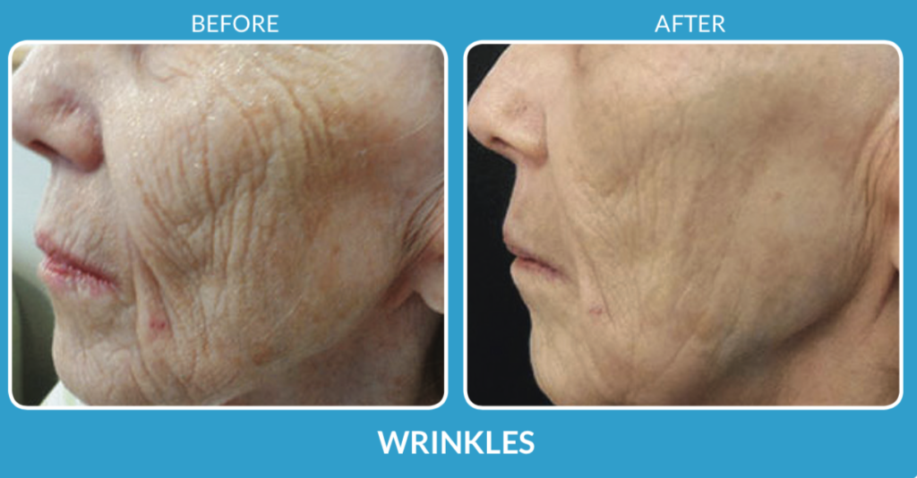 Wrinkles