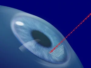 lasik.jpg